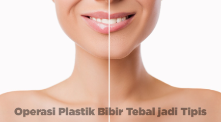 Operasi Plastik Bibir Tebal Jadi Tipis dengan Lip Reduction