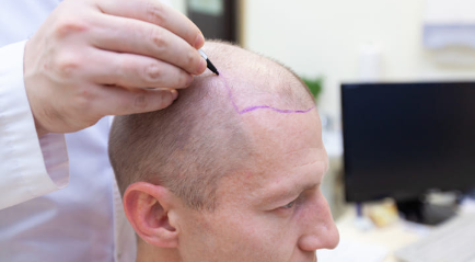 Operasi Menumbuhkan Rambut di The Clinic Beautylosophy