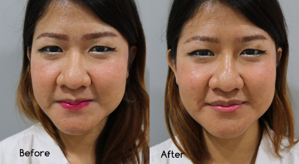 Ini Dia Gambar Botox Wajah Before After