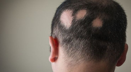 Ciri-ciri Alopecia Areata atau Botak Koin