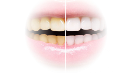 Teeth Bleaching dan Whitening Apa Bedanya? | The Clinic Beautylosophy