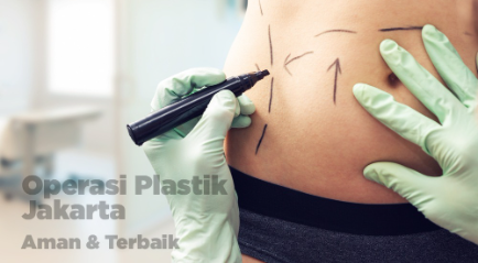 Operasi Plastik Jakarta Terbaik dan Murah, Aman.