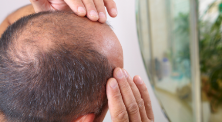 Cara Menumbuhkan Rambut Botak Permanen