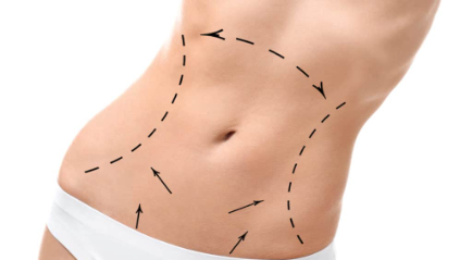 Liposuction dan Tummy Tuck Apa Bedanya? | The Clinic Beautylosophy