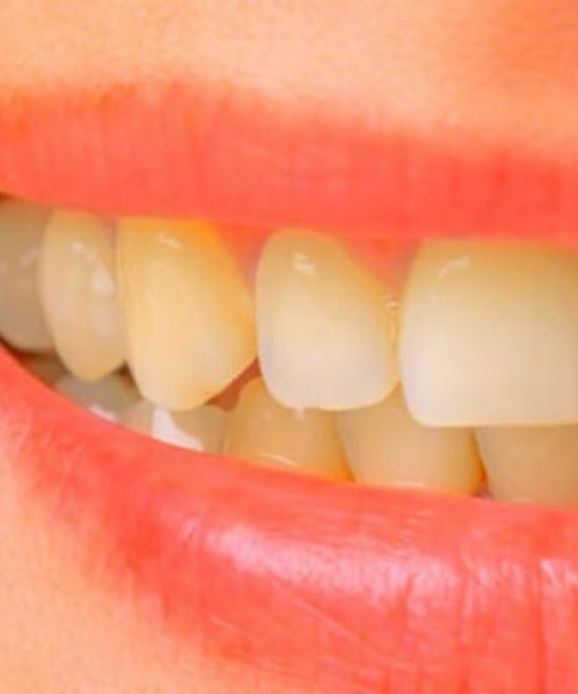 cara memutihkan gigi kuning cepat dan permanen bersama dokter spesialis ...