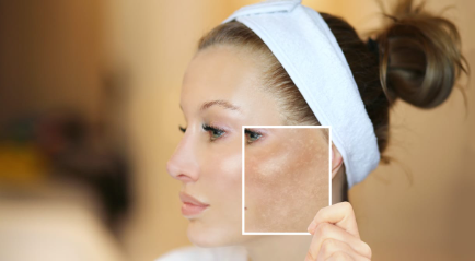 Melasma Treatment dan Manfaatnya untuk Kulit Wajah