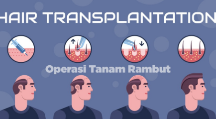 Operasi Tanam Rambut atau Hair Transplant Solusi Terbaik Atasi Kebotakan