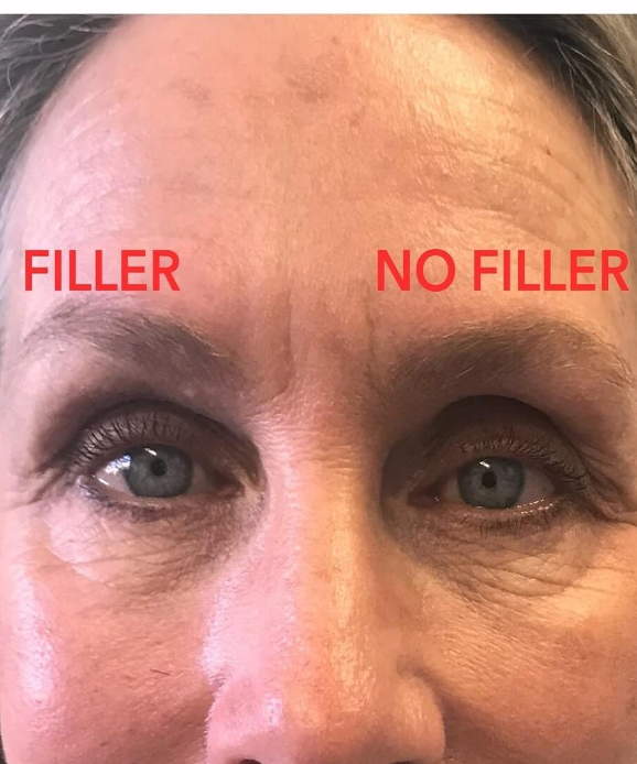 Pelipis Mata Cekung Mengganggu Penampilan? Anda Wajib Lakukan Ini!