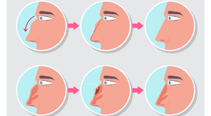 Cara Mengecilkan Hidung yang Besar dan Tebal