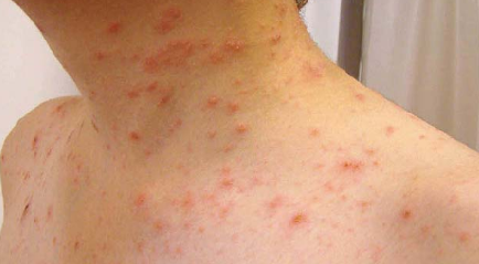 Apa itu Pityriasis Rosea? Penyebab dan Pengobatannya