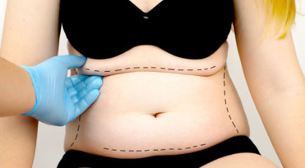 Operasi Plastik Perut (Tummy Tuck): Penjelasan, Manfaat hingga Resiko