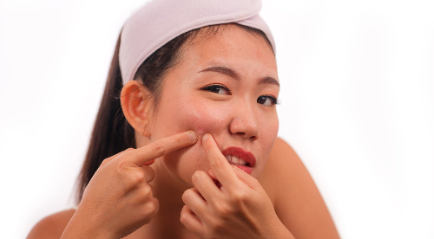 Pencegahan Jerawat Batu dengan Treatment Kecantikan Ini