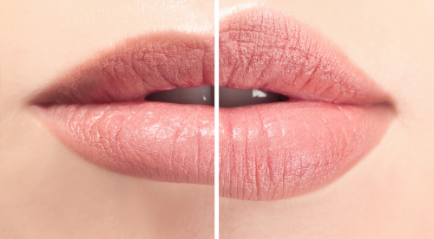 Cara Menebalkan Bibir Permanen