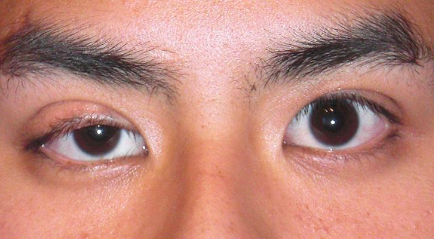 Apa itu Ptosis? Penyebab dan Cara Mengobatinya