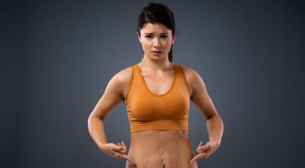 Stretch Mark Adalah? Penyebab dan Cara Mengobatinya | The Clinic Beautylosophy