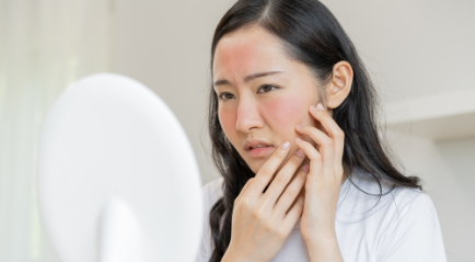 Apa itu Rosacea? Gejala, Penyebab, dan Cara Mengatasinya | The Clinic Beautylosophy