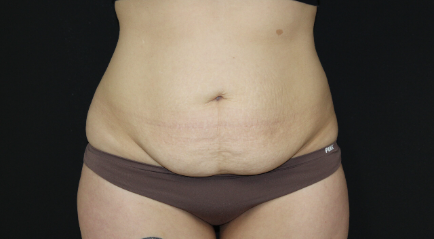 Apa itu Abdominoplasty? Operasi Meratakan Perut