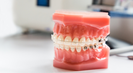 Pemasangan Kawat Gigi di Klinik Gigi Berkualitas