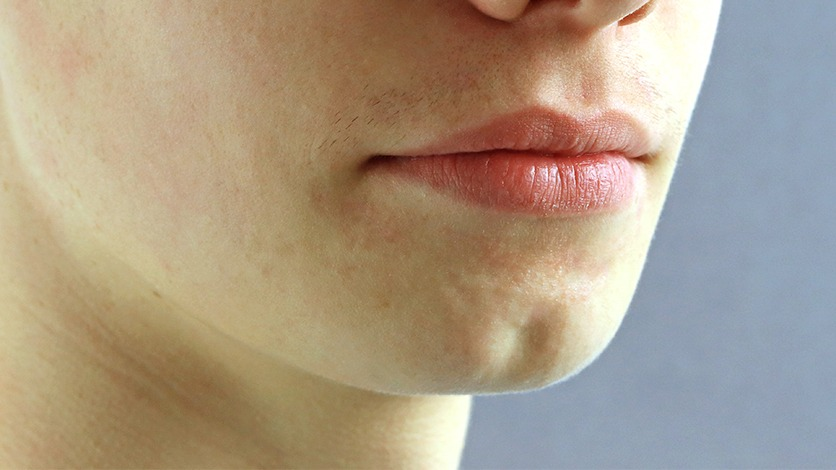 Cleft Chin - Operasi Dagu Belah | The Clinic Beautylosophy