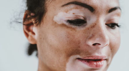 Apa itu Vitiligo? Bercak Putih Pada Kulit Tapi Bukan Panu