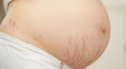 Ketahui Penyebab Stretch Mark Saat Hamil