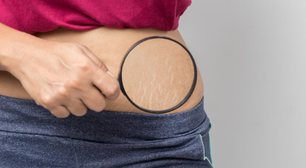 Cara Mengobati Stretch Mark Secara Alami