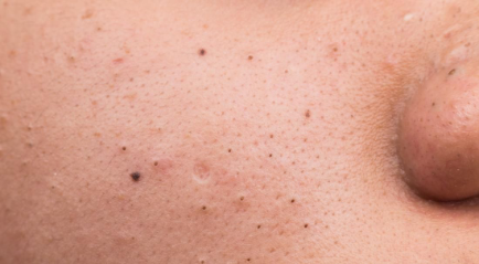 Apa itu Blackhead? Penyebab dan Cara Mengatasinya