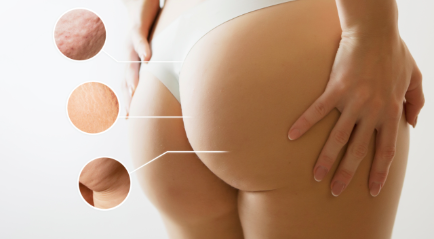 Berapa Biaya Buttock Augmentation Cost? | The Clinic Beautylosophy